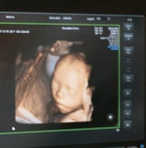 Obstetric 4D Ultrasound, Live HD Video Imaging