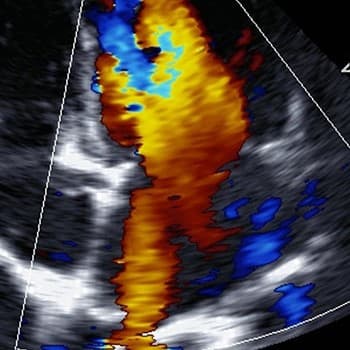 Echocardiogram