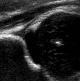 Paediatric Hip Ultrasound