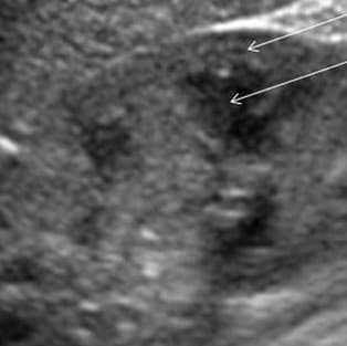 Transabdominal